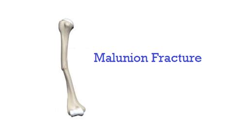 Malunion Fracture - Cause, Symptoms, Treatment - Samarpan