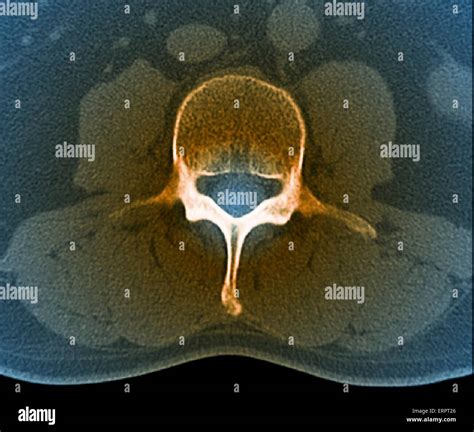 Lumbar vertebra hi-res stock photography and images - Alamy