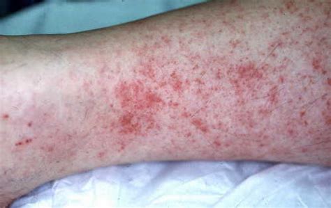 HealthoolRickettsial Pox Rash Pictures Atlas of Rashes Associated With ...