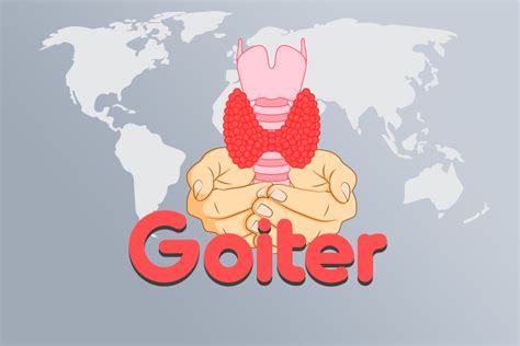 Understanding Goiter: Symptoms, Causes, and Diagnosis Codes