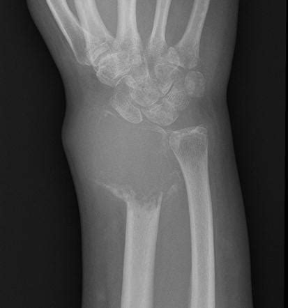 Lucent/lytic bone lesion - differential diagnosis (mnemonic) | Radiology Reference Article ...