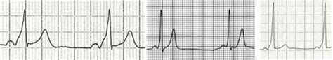 Delta Wave • LITFL Medical Blog • ECG Library Basics