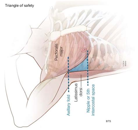 Chest tube | ACUTE GENERAL INTERNAL MEDICINE