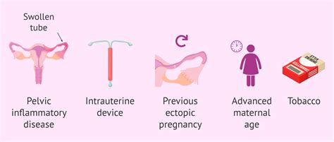 Is twin or multiple ectopic pregnancy possible?