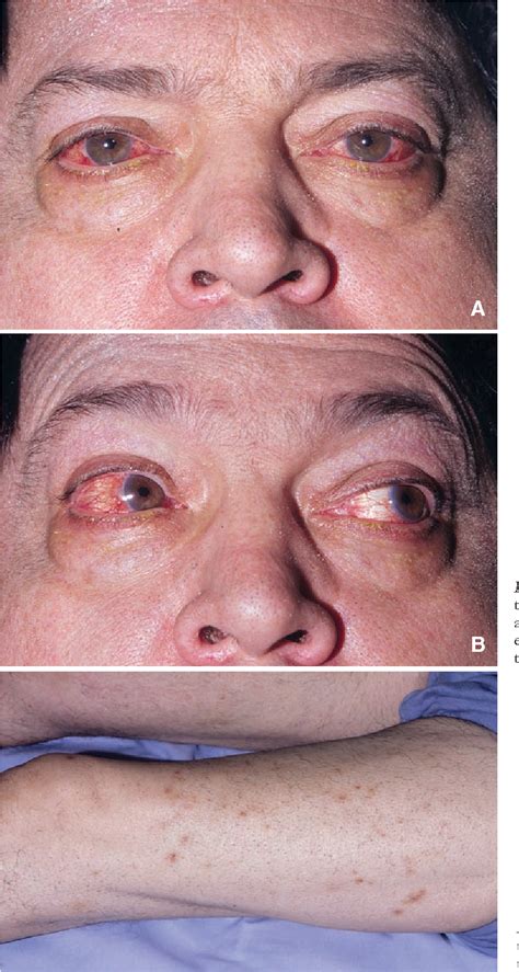 [PDF] Steroid refractory episcleritis as early manifestation of neurosyphilis. | Semantic Scholar