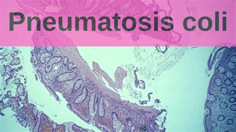 Pneumatosis Coli - Pathology mini tutorial - YouTube