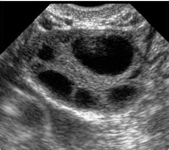 The difference between follicles and ovarian cysts | The IVF Specialist's Blog for IVF patients