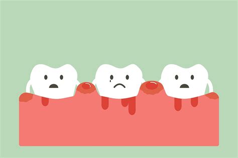 Bleeding Gums: How To Treat Them With Braces | Orthodontics in London