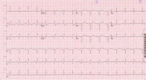 How to assess acute coronary syndrome | 12- lead EKG case