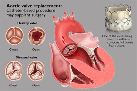 Aortic Valve Replacement - 7 Orange Hospital-Cardiology & Heart ...