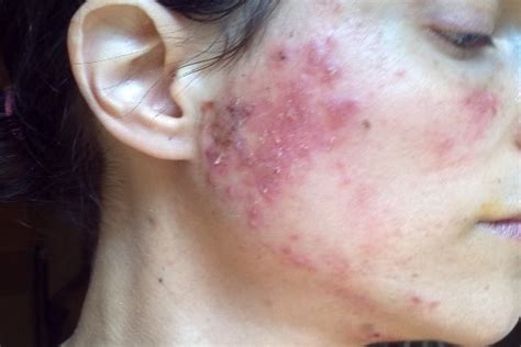 Skin Conditions That Look Like Acne - But Aren't