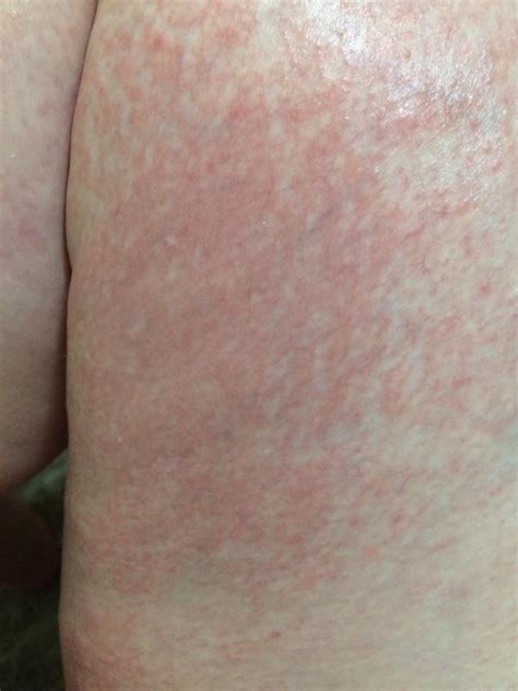 Painful rash on inner thighs when cold/hot : r/skin