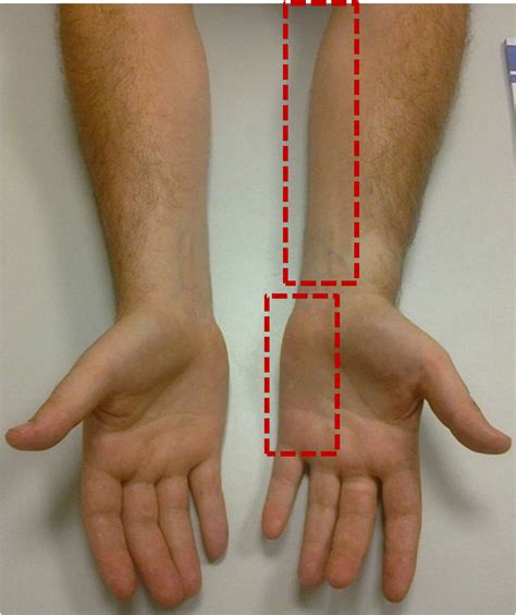 Ulnar Nerve Compression – Clínica Neuros | Neurocirujano Valencia