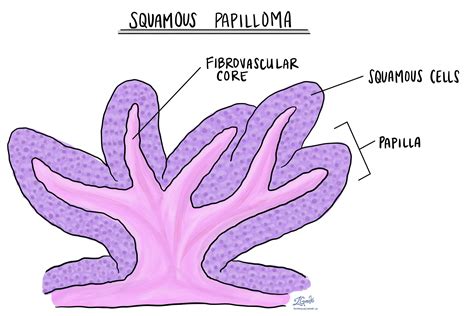 Squamous papilloma of the oral cavity | MyPathologyReport.ca