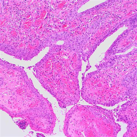 Histology of the specimen. Surface of mesenchymal hamartoma covered... | Download Scientific Diagram