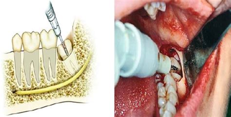 Impacted tooth- Sign, Symptoms, Treatments know in details