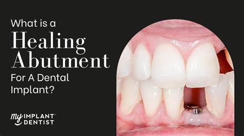 What Is A Healing Abutment For Dental Implant?