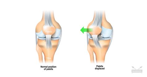 7 Exercises to Fix Knee Pain (And Prevent Patellar Tracking Disorder)