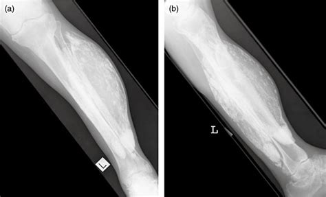 CALCIFIC MYONECROSIS | Buyxraysonline