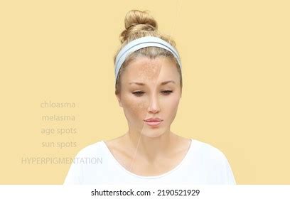 Hyperpigmentation Chloasma Melasma Age Spotspostinflammatory Hyperpigmentationhyperpigmentation ...