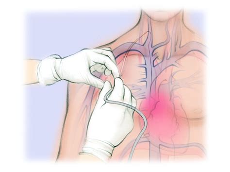 Hemodialysis Catheter — The Interventional Initiative