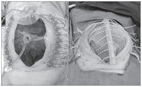 Temporary Abdominal Closure Techniques | Treatment & Management | Point of Care