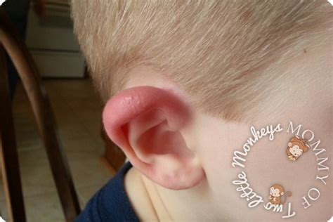 Red Swollen Ear Lobe - What Happened to His Ear!