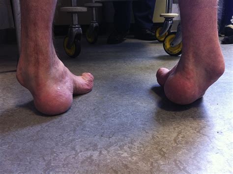 Assessment and management of cavus foot deformity - Orthopaedics and Trauma