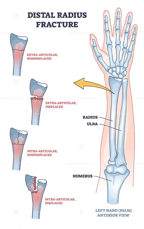 Distal radius fracture and broken arm bone types anatomy outline diagram – VectorMine
