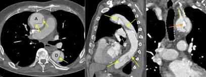 Thoracic aortic dissection - CT - Radiology at St. Vincent's University ...