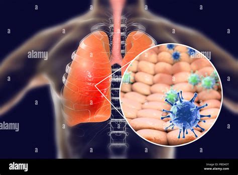 Viral Pneumonia Diagram