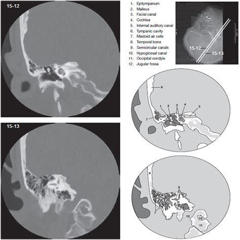 Temporal Bone - CT Scan - RadTechOnDuty