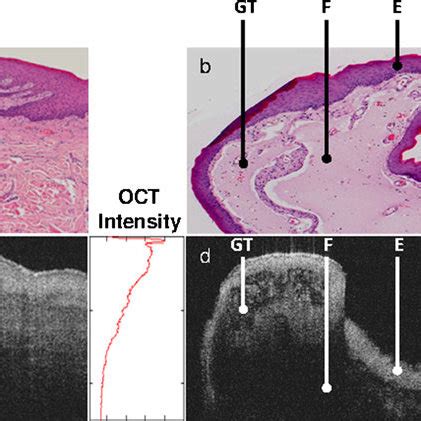 Histology sections (a–d) from which diagnosis was established by the ...