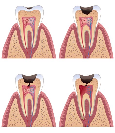 Tooth pain: Don't wait till it is too Late | Dental caries, Health and beauty tips, Tooth pain