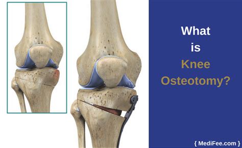 Knee Osteotomy: Surgery and Recovery