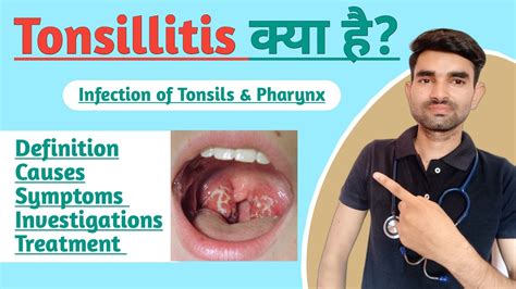 Tonsillitis in Hindi | Causes, Symptoms and Treatment of Tonsillitis ...