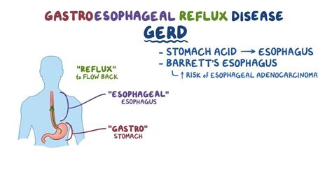 Sandifer Syndrome: What Is It, Causes, Diagnosis, and More | Osmosis