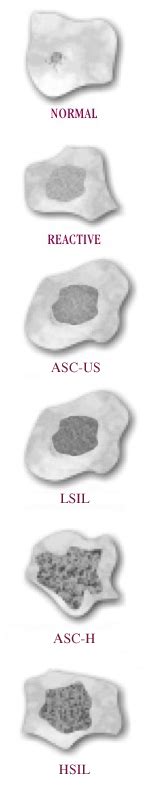 ASC-US vs. ASC-H? What is the difference? » Incyte Diagnostics