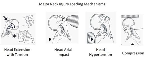 Cervical Spinal Injuries and Risk Assessment | IntechOpen