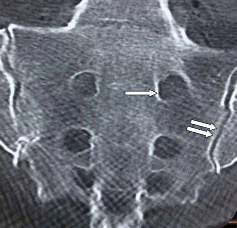 Sacroplasty procedural extravasation with high viscosity bone cement: comparing the ...