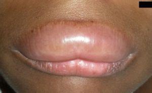 Angioedema: Symptoms, Causes, Risk Factors, Treatment and Prevention - Scope Heal