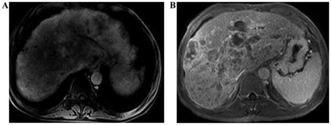 Application of dual-source CT perfusion imaging and MRI for the diagnosis of primary liver cancer