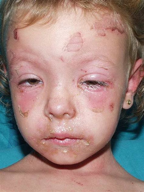 Scalded skin syndrome, staphylococcal scalded skin syndrome & treatment