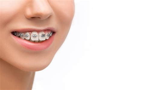 Brackets, ¿Cómo funcionan los brackets de ortodoncia?