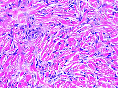 Pathology Outlines - Dermatofibroma / benign fibrous histiocytoma