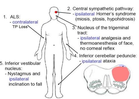 Wallenberg syndrome powerpoint pica syndrome - qustdw