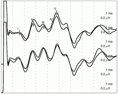 Brainstem Auditory Evoked Potentials | Neupsy Key