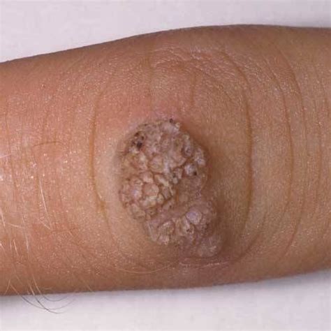 Typical warts (verucca vulgaris) look like hard, cauliflower shaped ...