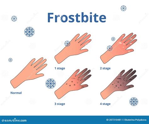 Frostbite Stages, Vector Cartoon Illustration of Hands Stock Vector ...