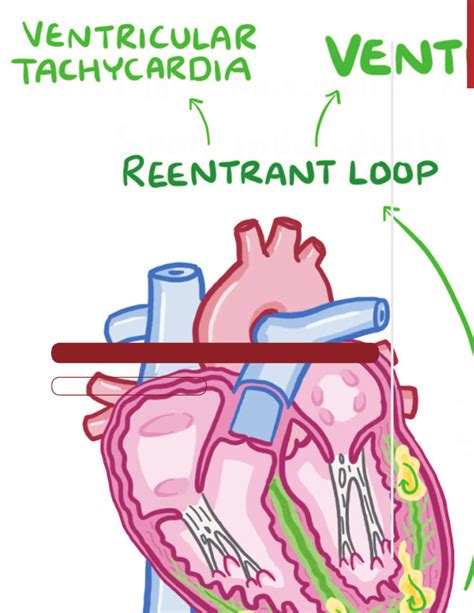 Ventricular fibrillation | Osmosis